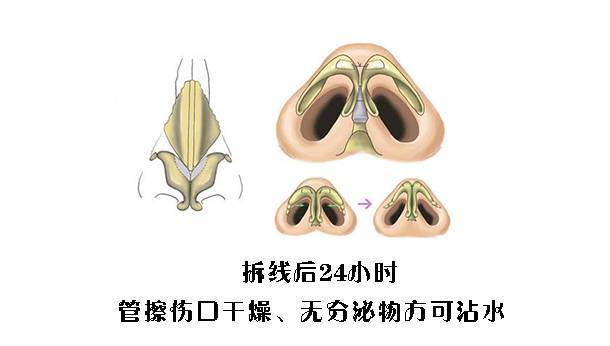 鼻整形手术后的注意事项