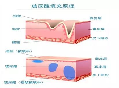 玻尿酸代谢之后皮肤会怎么样？