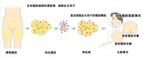 自体脂肪填充，人类自给自足的高级！