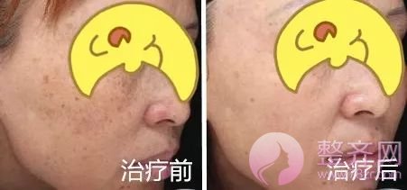 超激光美肤，带你揭开明星们的净肤秘密！