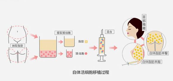 北京自体脂肪填充额头、苹果肌，案例分享