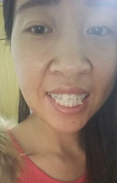 牙齿矫正前后对比案例，牙好笑的才好看！