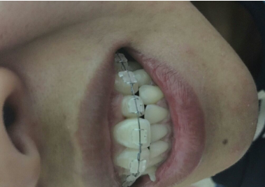 牙齿矫正前后对比案例，牙好笑的才好看！