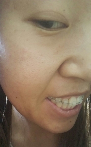 牙齿矫正前后对比案例，牙好笑的才好看！