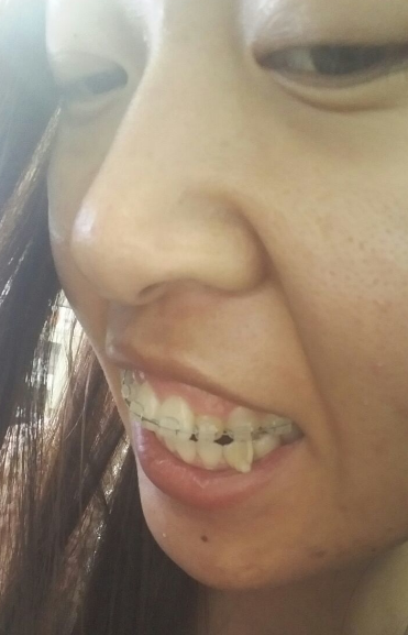 牙齿矫正前后对比案例，牙好笑的才好看！