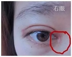 开眼角增生了怎么办？给你几点建议