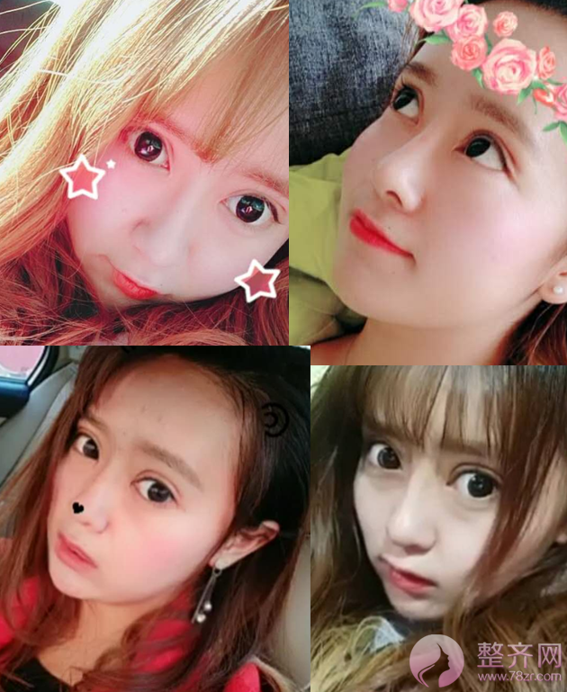 双眼皮+隆鼻的案例，改变不止一点点