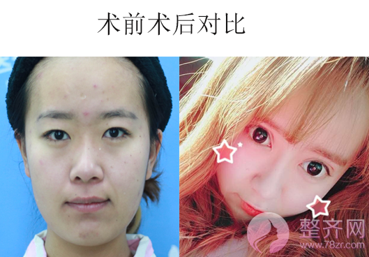双眼皮+隆鼻的案例，改变不止一点点