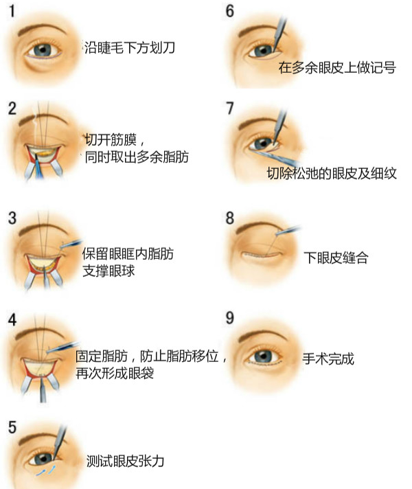 解决眼袋、黑眼圈，老阿姨秒变小姐姐