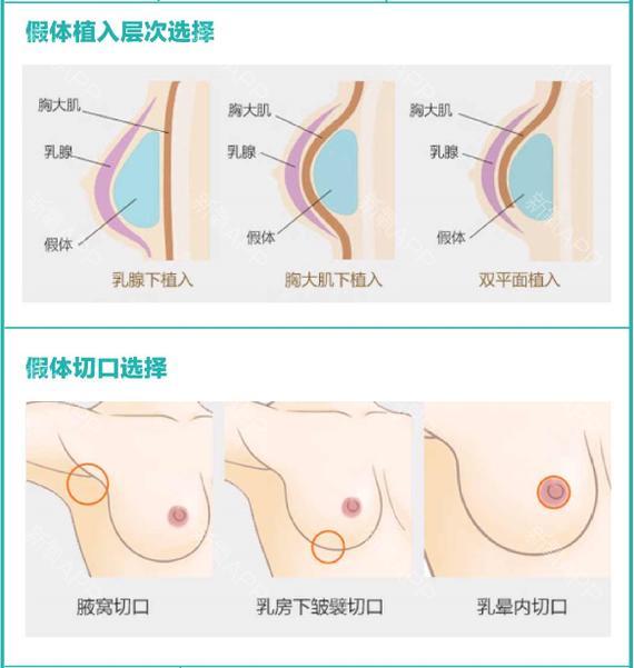 假体隆胸，让你摆脱地心引力