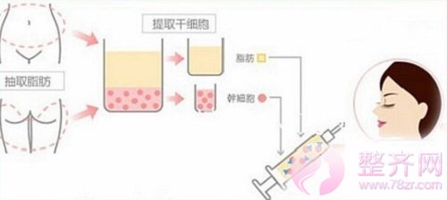 自体脂肪填充改善面部凹陷，拥有迷人苹果肌