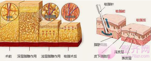 抽脂减肥手术对身体有危害吗？