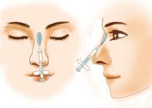 隆鼻能让脸变小 果堪比注射瘦脸
