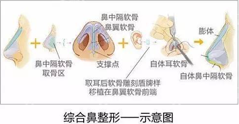 隆鼻能让脸变小 果堪比注射瘦脸