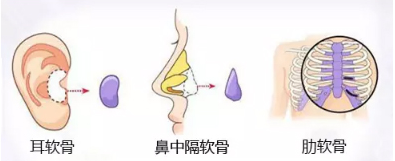 硅胶、膨体、软骨隆鼻材料全攻略