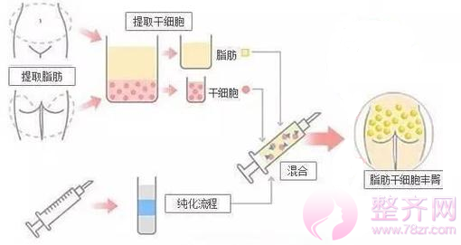 自体脂肪移植填充，又瘦又美！