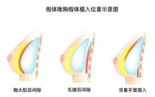 关于隆胸的这些疑惑，多方面解析看这里！