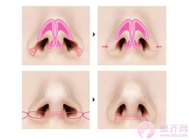 鼻翼缩小怎么做？我来告诉你！