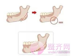 下颌角真的非去不可吗？