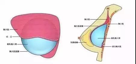 假体隆胸后，摸起来是什么感觉？