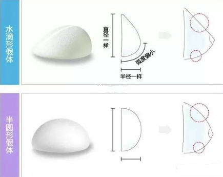 隆胸怎么选择适合自己的假体材料？