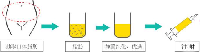 自体脂肪的术后恢复干货