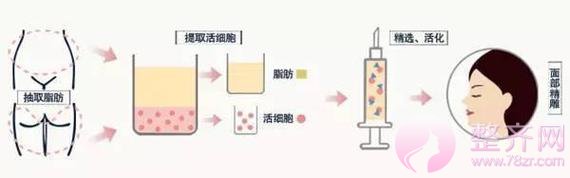 自体脂肪填充面部的五大误区，你都知道吗？