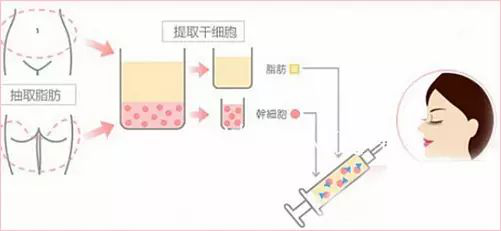 错把眼窝凹陷当做欧式深邃？醒醒吧！那样显老