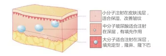 玻尿酸隆鼻，美得无形！