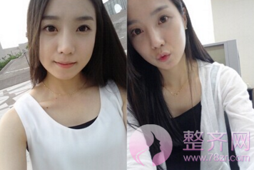 为什么那么多人热衷于下颌角手术？