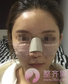 武汉鼻部手术、面部脂肪填充手术术后2个月案例分