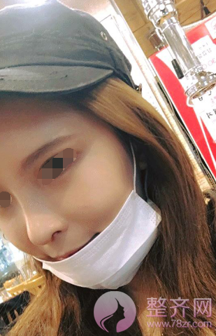 武汉鼻部手术、面部脂肪填充手术术后2个月案例分
