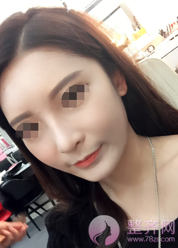 武汉鼻部手术、面部脂肪填充手术术后2个月案例分