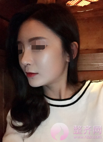 武汉鼻部手术、面部脂肪填充手术术后2个月案例分