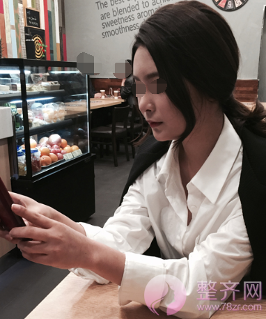 武汉鼻部手术、面部脂肪填充手术术后2个月案例分