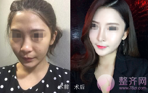 武汉鼻部手术、面部脂肪填充手术术后2个月案例分