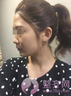 武汉鼻部手术、面部脂肪填充手术术后2个月案例分