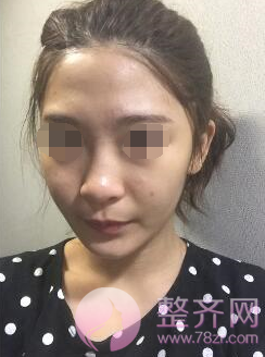 武汉鼻部手术、面部脂肪填充手术术后2个月案例分