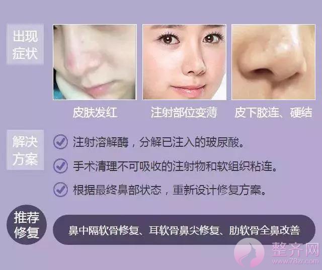 你的鼻整形失败了还有救吗？
