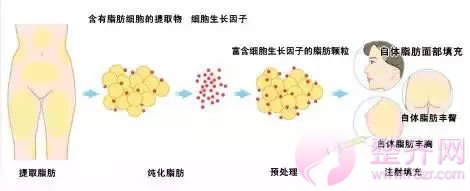 浅谈自体脂肪移植技术！