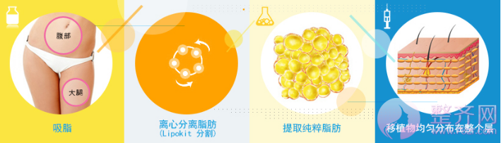 浅谈自体脂肪移植技术！