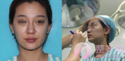 深圳自体脂肪面部填充案例