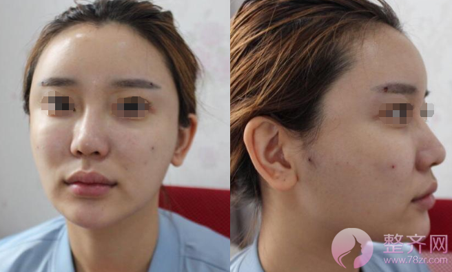 深圳自体脂肪面部填充案例