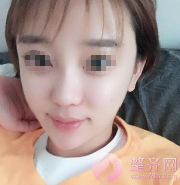 深圳自体脂肪面部填充案例