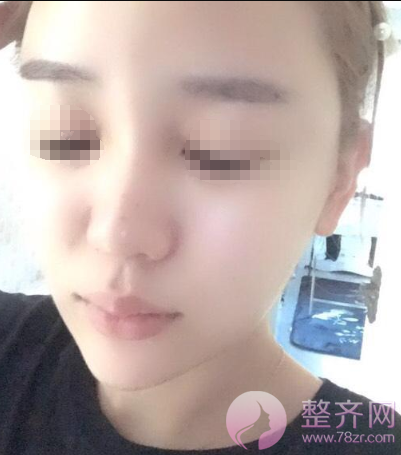 深圳自体脂肪面部填充案例