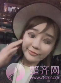 深圳自体脂肪面部填充案例