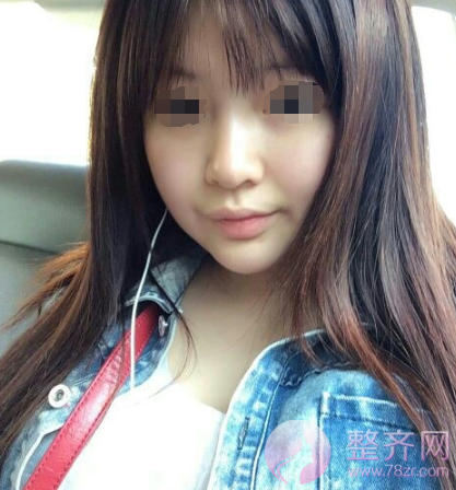 北京鼻部手术案例术后220天日记