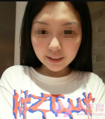 北京鼻部手术案例术后220天日记