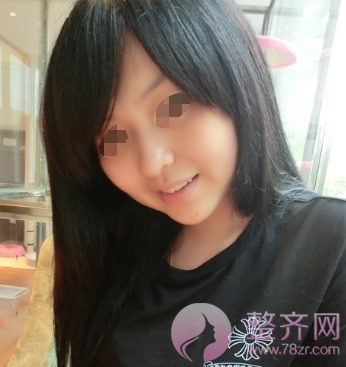 北京鼻部手术案例术后220天日记