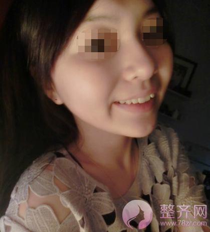 北京鼻部手术案例术后220天日记
